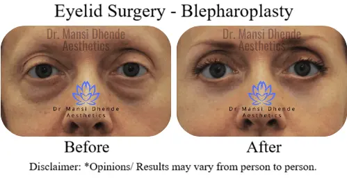 Eyelid-Surgery-Delhi-Before-After-Dr-Mansi-Dhende-Aesthetics