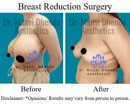 Breast Reduction Before-After Photo by Delhi's Plastic Surgeon Dr. Mansi Dhende