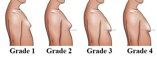 Grades of Gynecomastia