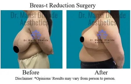 Breas-t Reduction Before After Results in Delhi NCR
