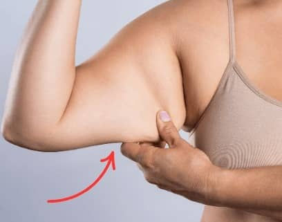Arm Lift in Delhi
