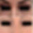 Tear Trough Filler - Before & After