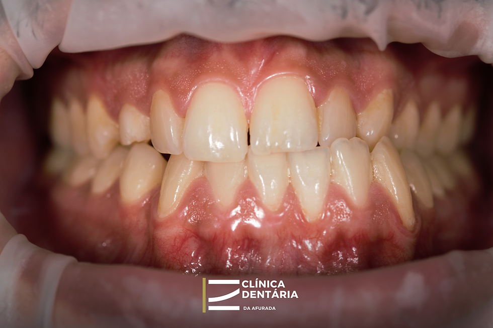 Aparelho-estético-antes