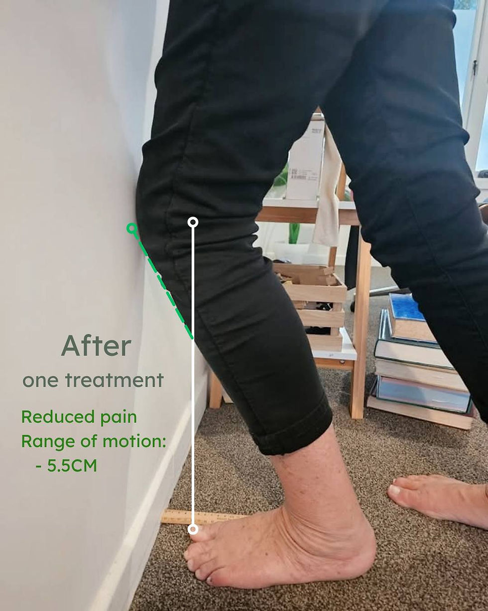 Post-treatment ankle mobility test showing 5.5cm range after one session