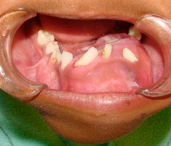 Tumores orales y mandibulares