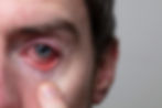 Uveitis