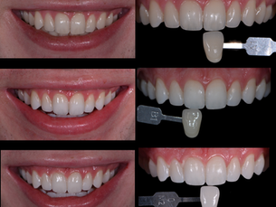 Teeth Whitening 101: How to Safely Get a Brighter, Whiter Smile
