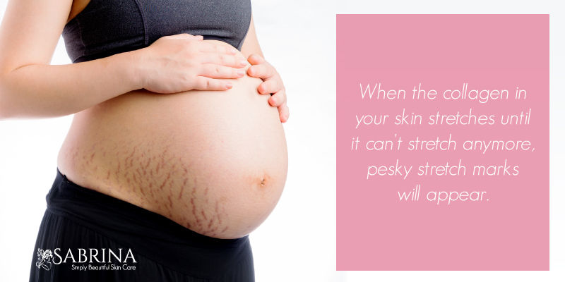 Pregnancy-StretchMarks