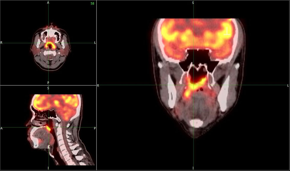Harnessing Graphene for Precise Radiotherapy Skin Dosimetry in Nasopharyngeal Cancer