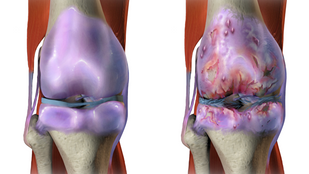 Osteoarthritis