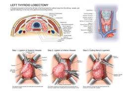 Left Thyroid Lobectomy Surgical Illustration