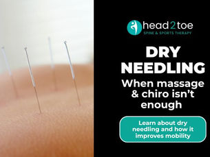 dry needling on a back of a patient to remove tension points