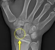 scapoid fracture 2.webp