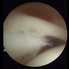 Type 3Slap tear 上肩關節唇前後撕裂