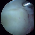 Type 2 Slap tear 上肩關節唇前後撕裂