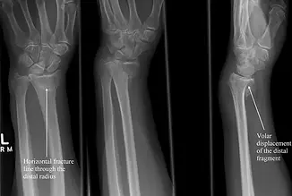 barton fracture.webp