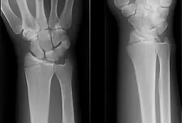 chauffer fracture.webp