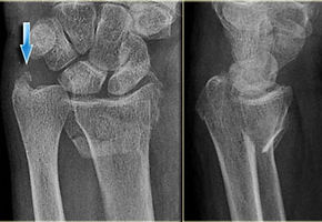ulnar styloid process fracture.jpg