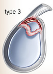 Type 3 Slap tear 上肩關節唇前後撕裂
