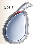 Slap Tear 上肩關節唇前後撕裂