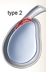 Type 2 Slap tear 上肩關節唇前後撕裂