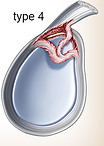Type 4 Slap tear 上肩關節唇前後撕裂