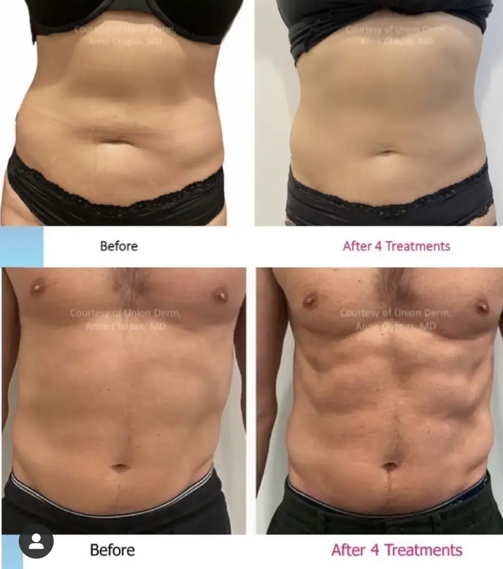 Accufit Results