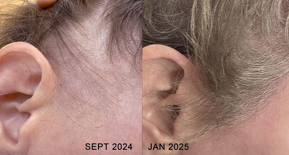 Comparison of hair growth for a Brighton Aesthetics client: before starting the Keralase Hair Re-Growth Treatment in September 2024 and after four months of treatment in January 2025.