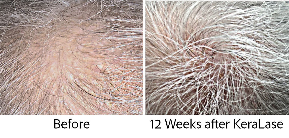 Our clients typically start seeing new hair growth 2-3 weeks after their first KeraLase hair treatment.