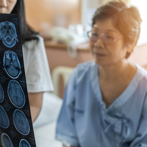 Multiple sclerosis (MS)