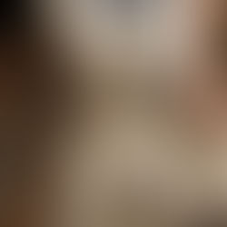 Dolor de rodilla al subir escaleras; causas y tratamiento