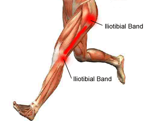 Bandelette iliotibiale.jpg.gif