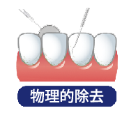 物理的除去.png