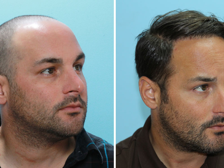 From Hair Loss to Hair Gain: A Patient's Experience with FUE at Laksha Care