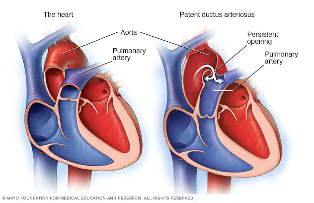 Tratamiento de la persistencia del conductor arterioso