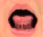 tongue tie release