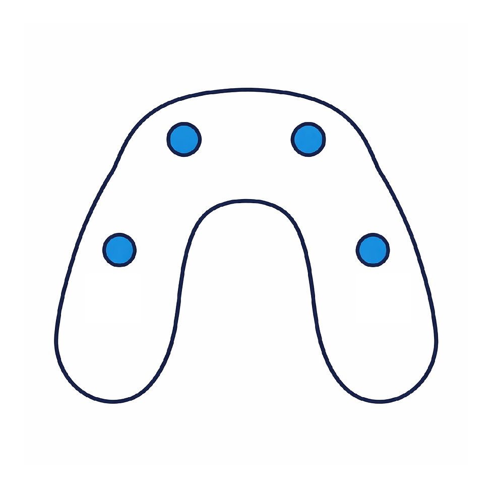 Over Denture illustration for Full Arch Guided Surgery