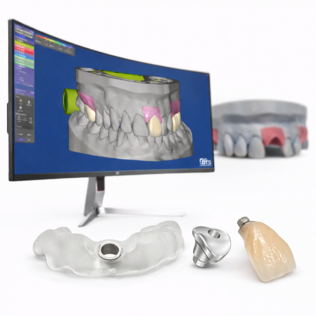 Complete digital implant workflow from treatment planning to final restoration