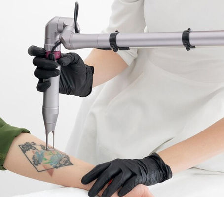 How Much Does Tattoo Removal Cost?