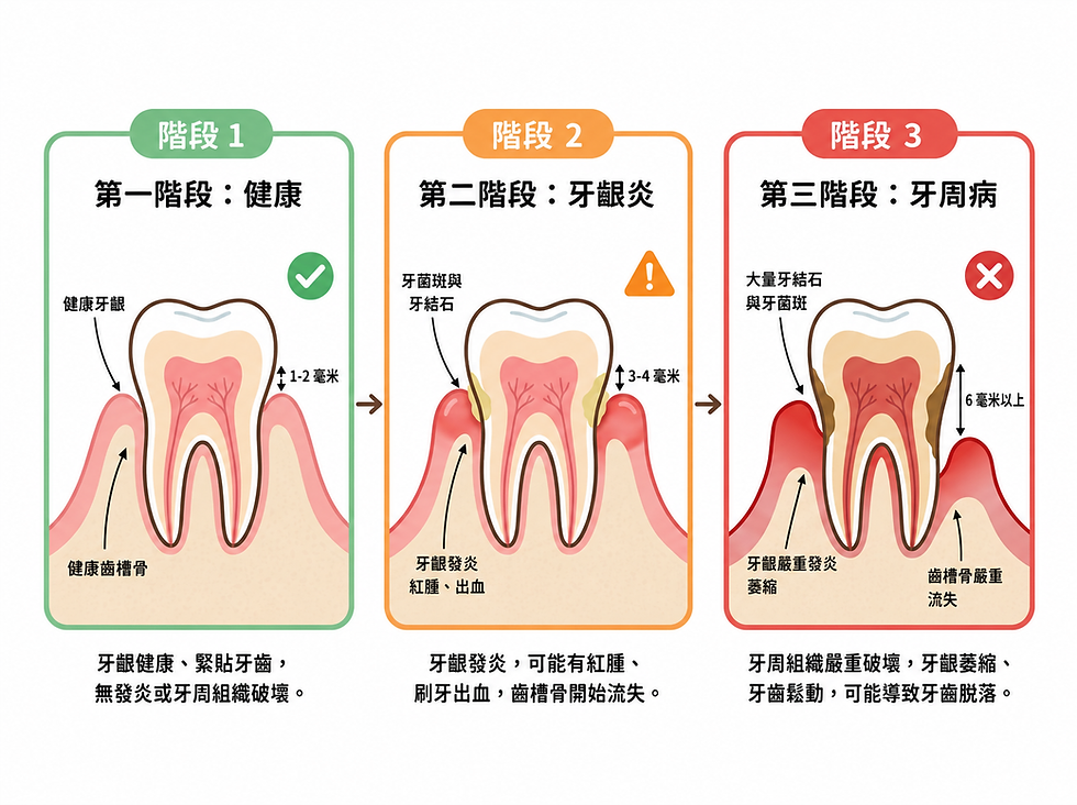 牙周病三階段進程:第一階段健康牙齦(1-2mm牙周袋),第二階段牙齦炎(3-4mm,可逆轉),第三階段牙周病(6mm以上深袋,骨質流失,需治療)