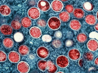 No hay razón para pánico excesivo por Mpox: Virólogo