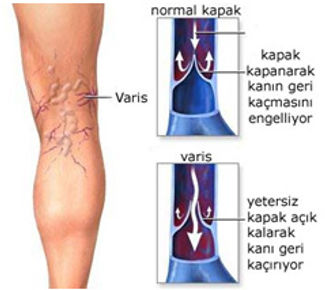 Varis nedir, nasıl oluşur?