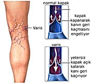 Varis nedir, nasıl oluşur?