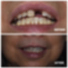 Anterior Implant Crown