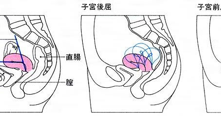 子宮の位置異常・その1