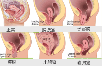 再開！子宮防衛隊シリーズ