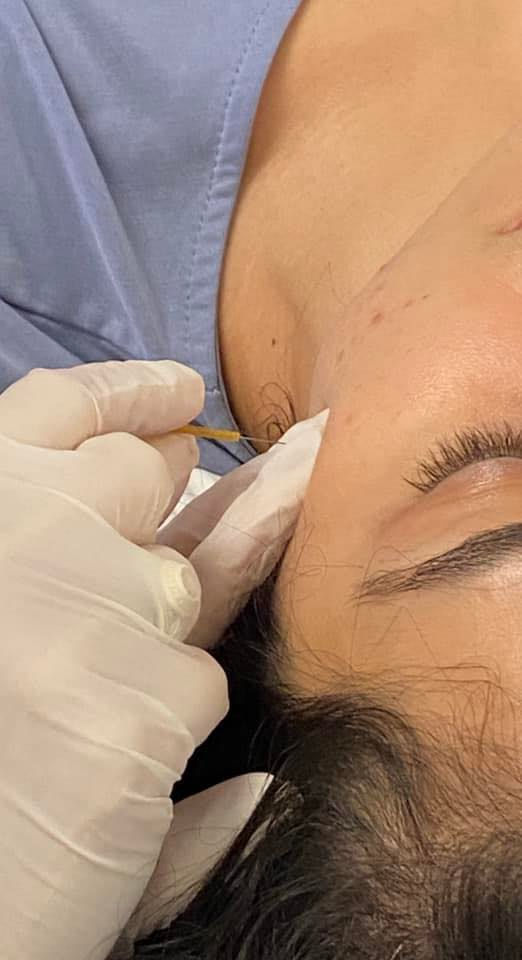 Dry needling the masseter muscle for jaw pain