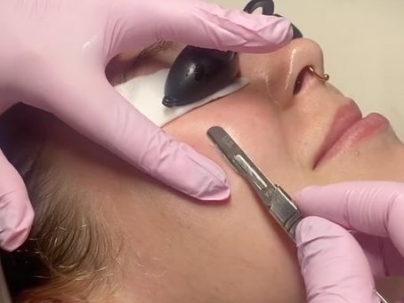 Acne Isn’t Just About Clean Skin — It’s About Balance