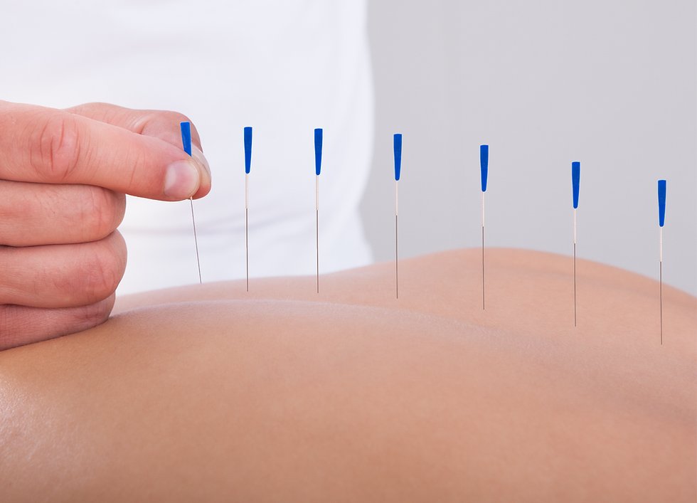Acupuncture Therapy Session_edited.png