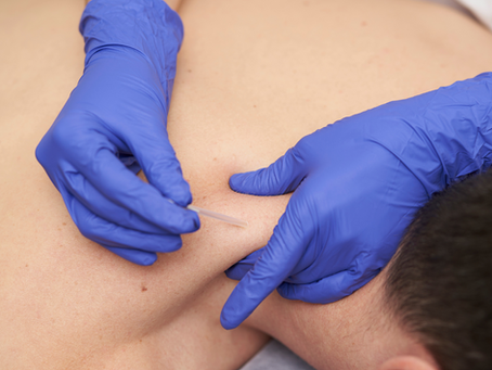 Physical therapist performing trigger point dry needling to a male patient through his upper trapezius.